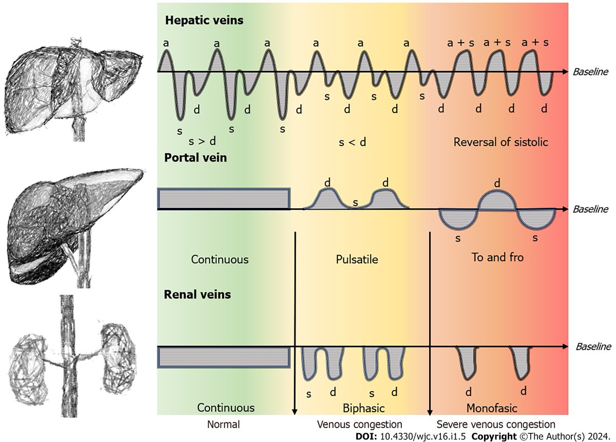 🔴 Venous Doppler flow patterns, venous congestion, heart disease and renal dysfunction: A complex liaison #2024Review #openaccess 

wjgnet.com/1949-8462/full…
#Epeeps #CardioTwitter #EHRA2024
 #CardioEd #Cardiology #FOAMed #meded #MedEd #Cardiology #CardioTwitter #cardiotwitter