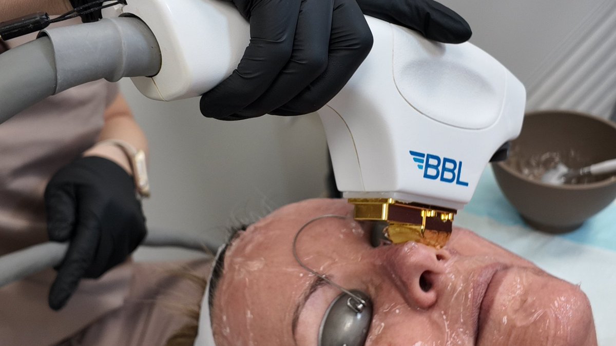 Fast-track rejuvenation with The Klinic's BBL Laser. Age-defying results, no frills. 🚀

#BBLRevolution #SkinRefresh #Medspa #FacialLasers <a href="/sciton/">Sciton Inc.</a>

theklinic.co