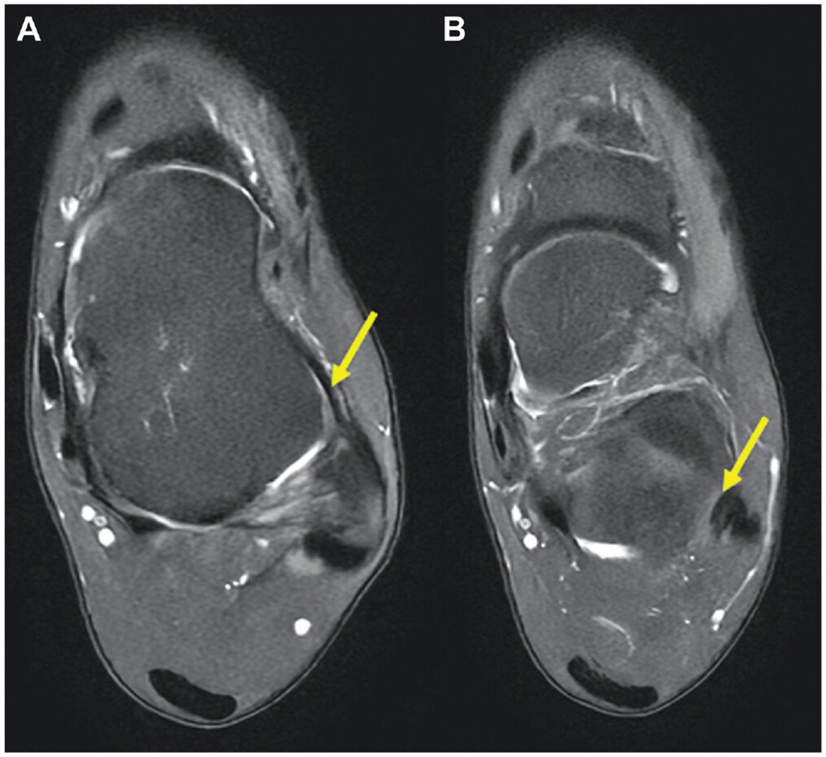 Interesting study demonstrates an evolution of MRI characteristics following ATFL reconstruction suggesting a process of graft maturation. ow.ly/Xbu250R9bmy