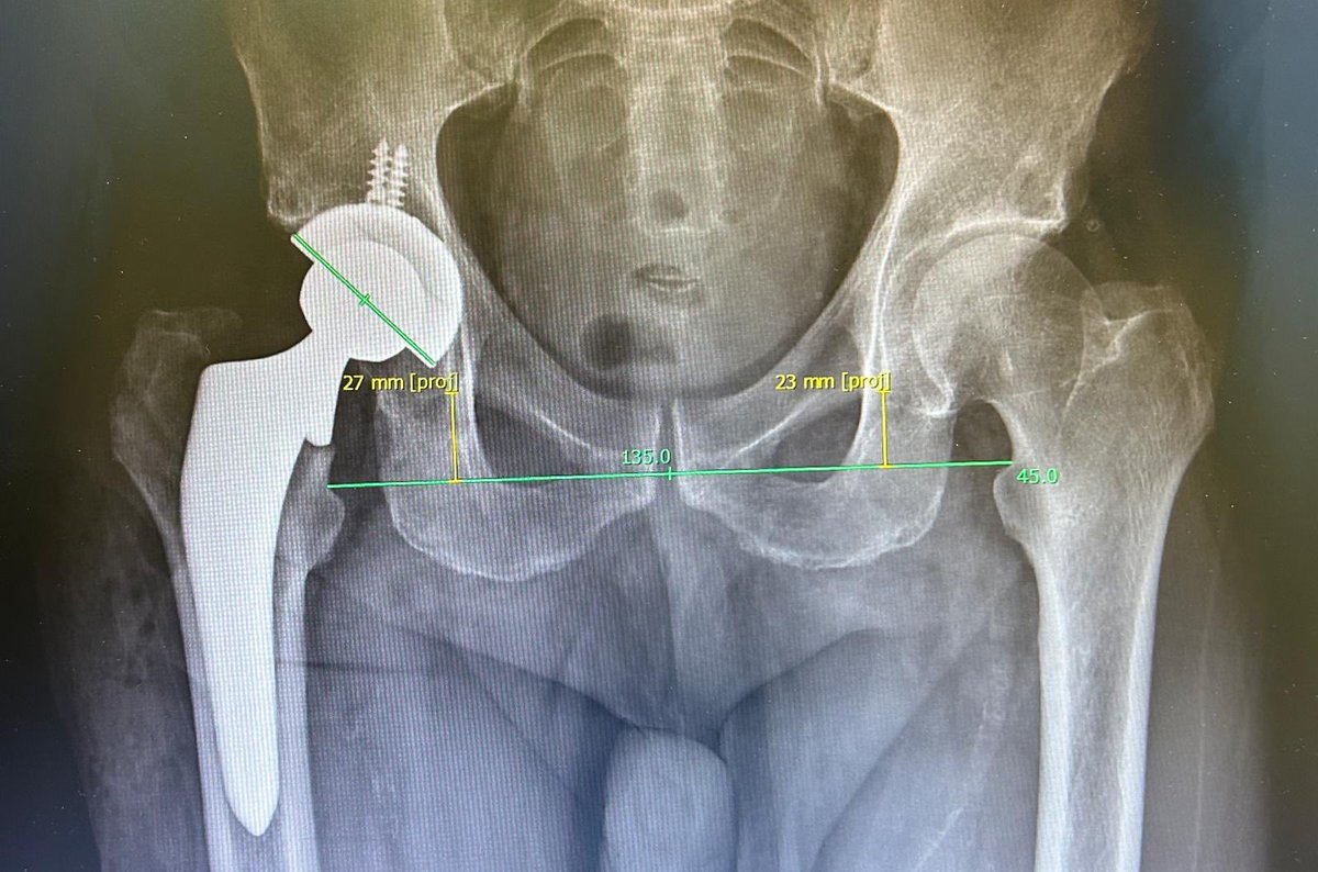 cothsc's tweet photo. This is what we are focused on… The MAASH technique #themaashtechnique 45 ABD and 4mm of LLD 10 degree of combined anteversion #nodislocation #totalhipreplacement https://t.co/xFUfDYMFpl