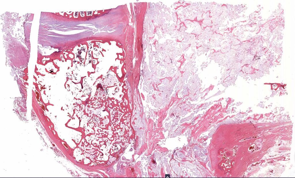 30 yo M. Bone mass extending into soft tissue. Your diagnosis? Can you figure out which bone it is from this pic? WSI digital slide: kikoxp.com/posts/8265. Answer & video: kikoxp.com/posts/4589 #BSTpath #pathologists #pathology #pathTwitter #neuropath #orthotwitter