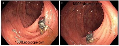 Wow large insect came up from the opposite end?  #endoscope #endoscopy #colonoscopy 1800endoscope.com