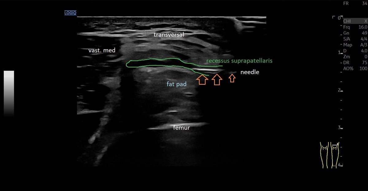 SportklinikBern's tweet photo. #Ultrasoundguidedinjection of the knee with #arthrexprp and #ostenilplus for #arthrosis - in plane and out of plane view - #mskus #pocus #pocushub #GElogiqE10r3 #kneesrthrosis https://t.co/xyhqvksWly