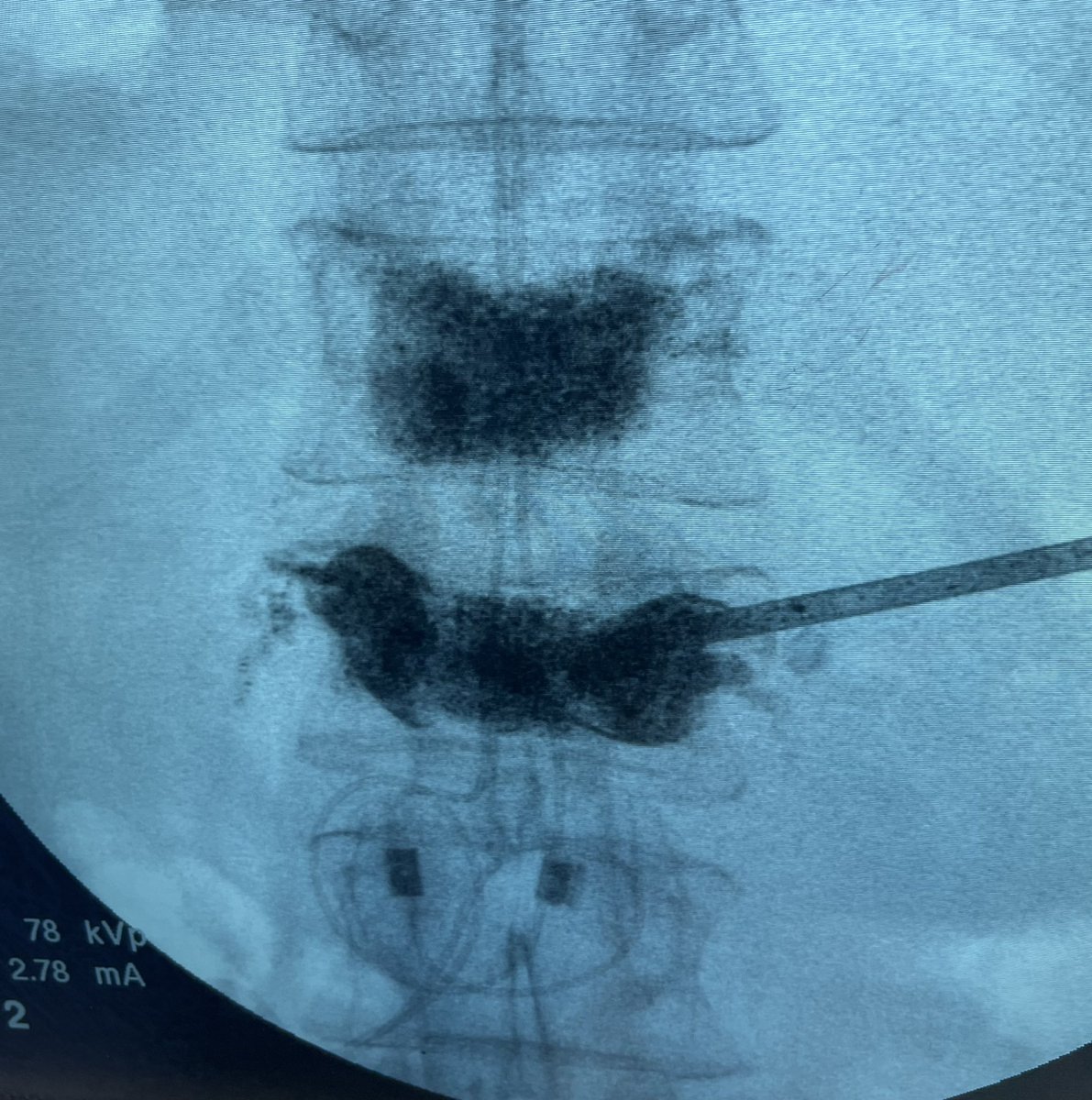 Trilateral access to the vertebral body used to fill a stubborn-to-fill center portion of the vertebral body. @JacobFlemingMD @ImagingDoctor @neuroradiology @WayneOlan  @SIRspecialists @ASIPP @ASPN_PainNeuro