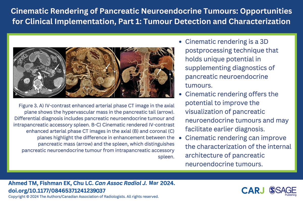 These recently published articles assess the role of the cinematic rendering of pancreatic neuroendocrine tumours: Part 1 (doi.org/10.1177/084653…) & 2 (doi.org/10.1177/084653…) @LindaChuMD @ctisus @Hopkins_Rad @CARadiologists @SageJournals #radiology #radres