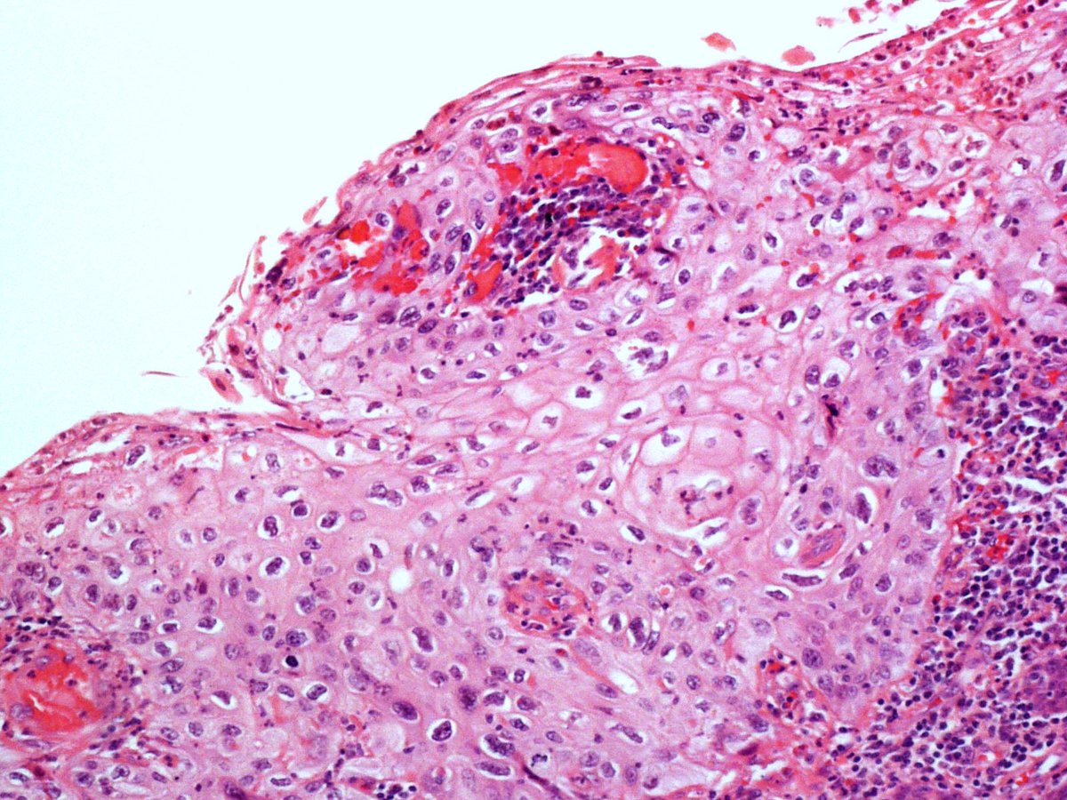 Be aware of. A 49 yo man with a 0.4x0.4cm nodular lesion in the glans. Final DX. Warty  Penile Intraepithelial Neoplasia HPV +. #pathology #pathologists #pathresidents #GUpath