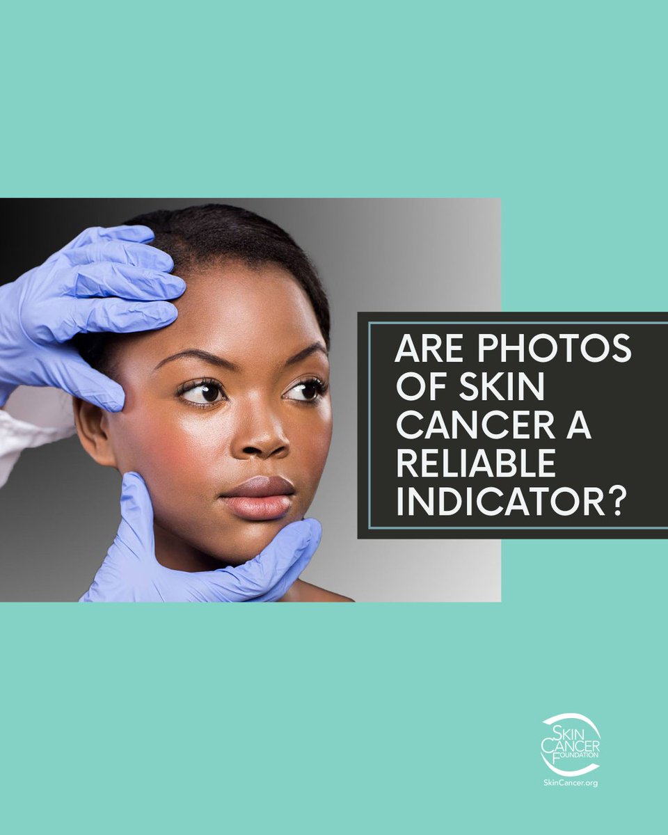 Wondering if skin cancer photos are a reliable indicator? Check out our 'Ask the Expert' article. Learn about the importance of consulting a dermatologist and understanding skin cancer signs. skincancer.org/blog/ask-the-e… #SkinCancerAwareness #SkinHealth #AskTheExpert