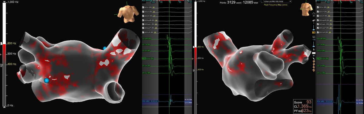 #Epeeps who perform #CNA. LA peak frequency is valuable to find candidate GP sites beyond fractionation, especially for LI/LSGP, which are harder to target anatomically. Here peak frequency pointed to two regions that had + HFS and vagal response with ablation. @PennEPFellows