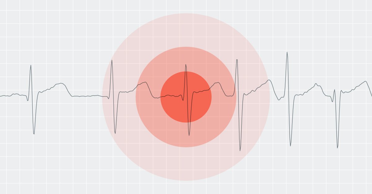 Could screening for atrial fibrillation be the next vital sign? Read the Inside Beat blog article to learn why screening for asymptomatic AF could be beneficial to patients. bit.ly/40kxr40