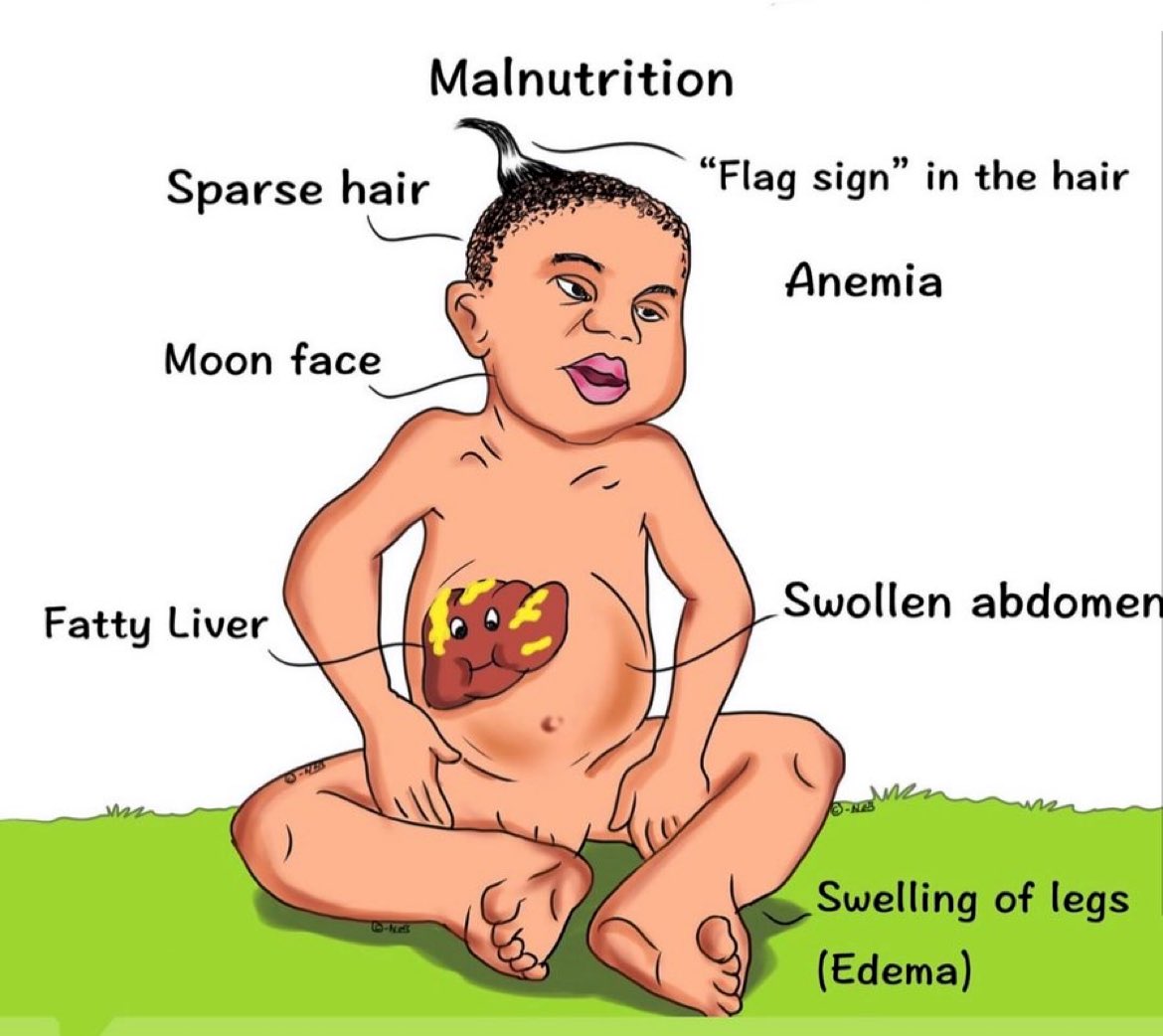 🙋‍♂️ What condition is shown here? #NutritionMatters #Nutrition #MedEd H/T @drkeithsiau