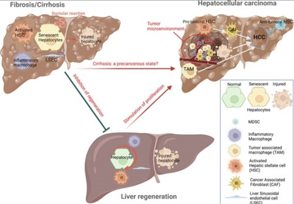 Have you thought why the fibrotic liver is much more prone to cancer than the heart or the kidney ? Because of its amazing regenerative potential. This review explains the link between liver fibrosis, regeneration and cancer. #LiverTwitter tinyurl.com/bdjanak3