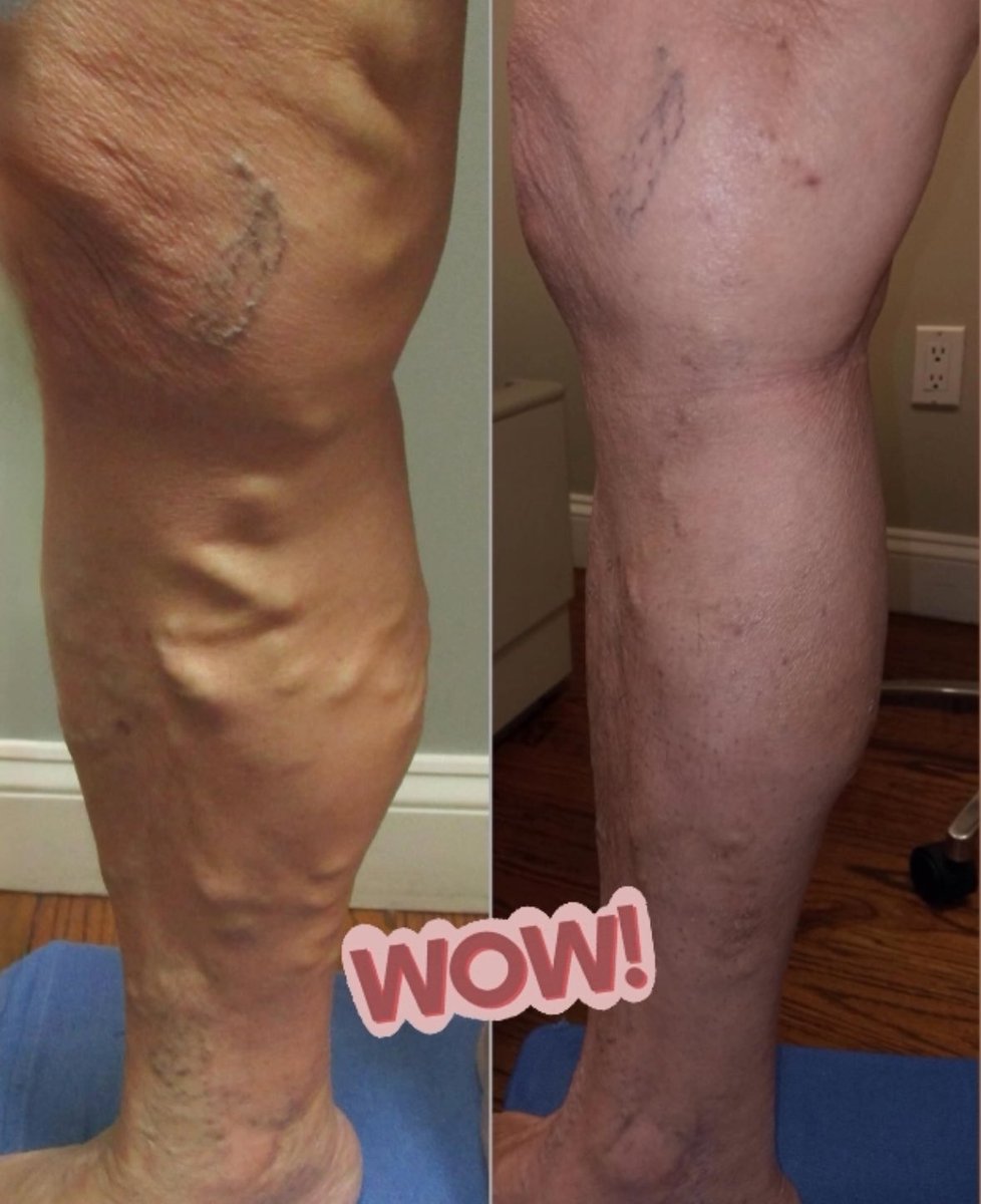 Before & After: Say Goodbye to Varicose Veins!

➡️ Get the Legs You Love!🩵

 ✨ Ready to learn more?
- Radiofrequency ablation (RFA)
- Ambulatory phlebectomy
- Venaseal™
- Sclerotherapy

➡️ Visit VeinInstitute.com to schedule a consultation at your nearest location.
