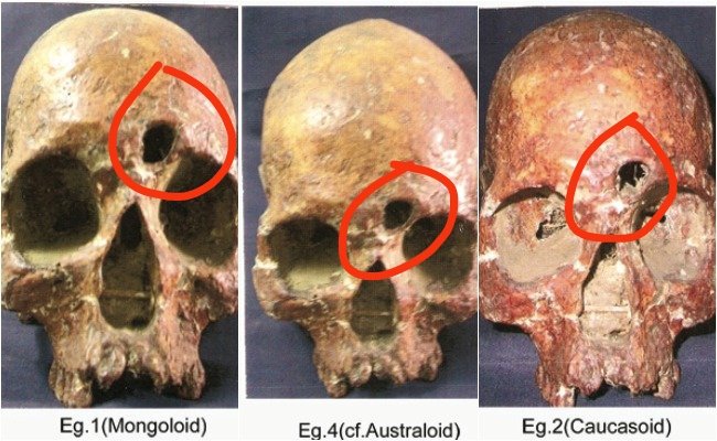 Also the reason why you see these marks on their skulls is because almost all of them were suffering from a disease called Potts puffy tumor which is caused by Streptococcus,Haemophilus influenzae,Staphylococcus aureus,Fusobacterium bacterias which mostly affects maritime traders