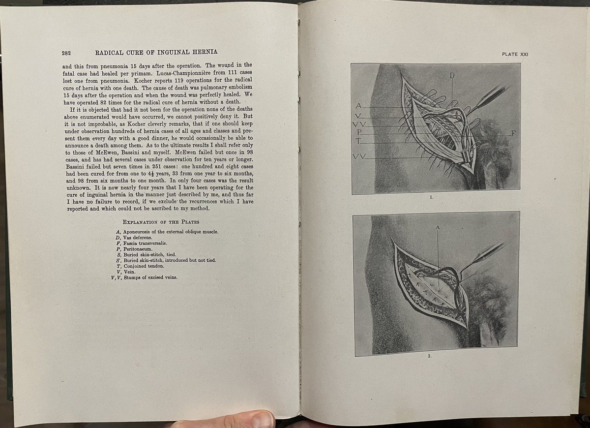 “It gratified me to note that in twenty years I have probably not had a recurrence…It would weary you to have me discuss this subject farther” Halsted on inguinal hernias Going to try that line out at @SAGES_Updates “it would weary you to have me discuss this subject farther”