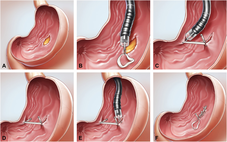 Listen to the podcast of 'New endoscopic closure technique, 'internal traction-assisted suspended closure,' for GI defect closure: a pilot study (with video)' by Gong et al. giejournal.org/content/podcast