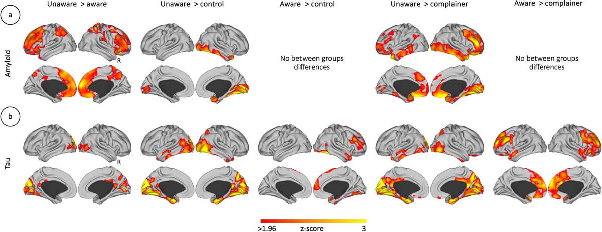 Eli Bueicheku (@neuroeli) on Twitter photo So happy to see our latest work out! "Multi-modal Neuroimaging Phenotyping of Mnemonic Anosognosia in the Aging Brain" in Comms Medicine. Great collaboration between the <a href="/SepulcreLab/">Jorge Sepulcre Lab</a> and <a href="/_PatriziaV/">Patrizia Vannini</a> 's lab! So happy to see our latest work out! "Multi-modal Neuroimaging Phenotyping of Mnemonic Anosognosia in the Aging Brain" in Comms Medicine. Great collaboration between the <a href="/SepulcreLab/">Jorge Sepulcre Lab</a> and <a href="/_PatriziaV/">Patrizia Vannini</a> 's lab!