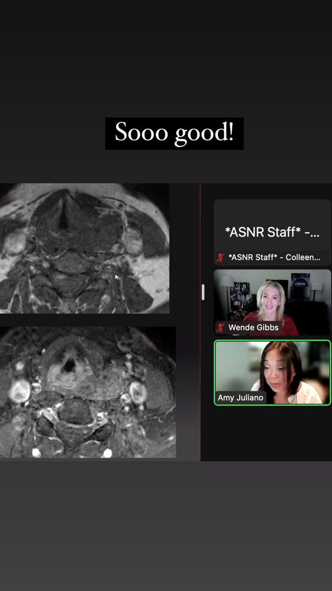 Wende Gibbs (@wendengibbs) on Twitter photo Wow… <a href="/amyfjuliano/">Amy Juliano</a> - I have learned more in these 30 min than in all of residency 🙈- thank you! Wow… <a href="/amyfjuliano/">Amy Juliano</a> - I have learned more in these 30 min than in all of residency 🙈- thank you!
