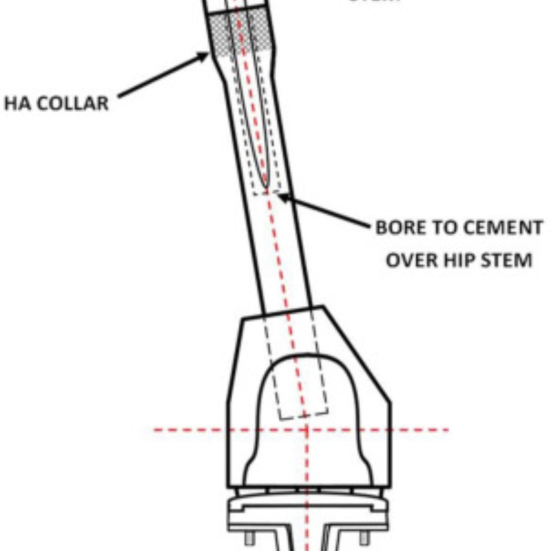 The custom cement-over megaprostheses (CCOM) technique demonstrates good implant survivorships and satisfactory patient-reported outcomes in complex, often frail patients who have compromised bone stock. authors.elsevier.com/a/1igil38vD3A2…