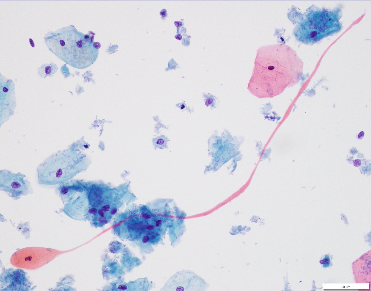 Never ending 'tadpole' in an otherwise uneventful cervical PAP. 
#cytopath