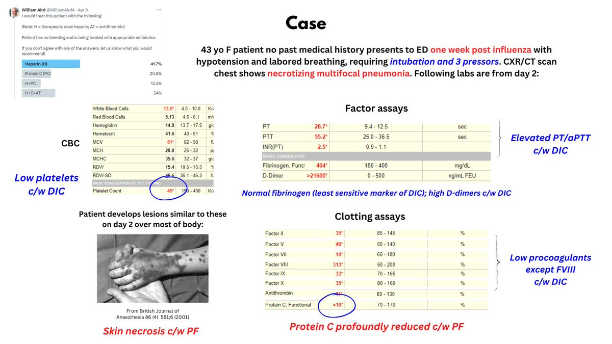 PURPURA FULMINANS (PF) I tweeted a poll asking how you would treat a patient whose database is w/f PF. Heparin was the most popular answer, which is the one treatment supported by practice guidelines. For full explanation, see: thebloodproject.com/purpura-fulmin…