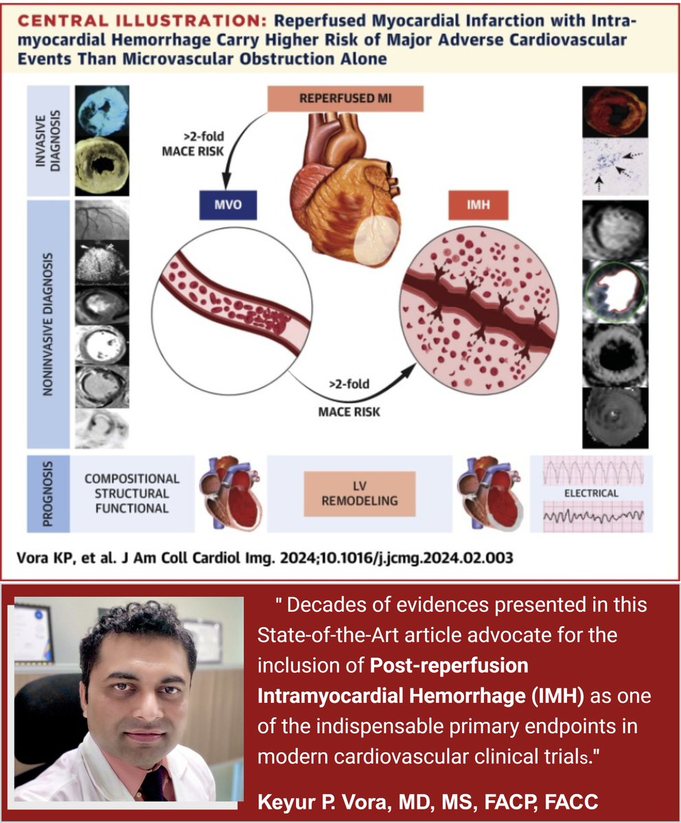 Keyur P. Vora (@keyurvoramd) on Twitter photo JACC: CV Imaging today !!!
Decades of findings point that Post-reperfusion Intramyocardial Hemorrhage is an indispensable link between favorable and unfavorable outcomes in AMI management. <a href="/rohandkumar1/">Rohan Dharmakumar</a> <a href="/AndreasKumarMD/">Andreas Kumar MD</a> <a href="/IUKrannertHeart/">Krannert Cardiovascular Research Center</a> <a href="/IUCVInstitute/">IU Cardiovascular Institute #OneIUCV</a>
jacc.org/doi/10.1016/j.… JACC: CV Imaging today !!!
Decades of findings point that Post-reperfusion Intramyocardial Hemorrhage is an indispensable link between favorable and unfavorable outcomes in AMI management. <a href="/rohandkumar1/">Rohan Dharmakumar</a> <a href="/AndreasKumarMD/">Andreas Kumar MD</a> <a href="/IUKrannertHeart/">Krannert Cardiovascular Research Center</a> <a href="/IUCVInstitute/">IU Cardiovascular Institute #OneIUCV</a>
jacc.org/doi/10.1016/j.…