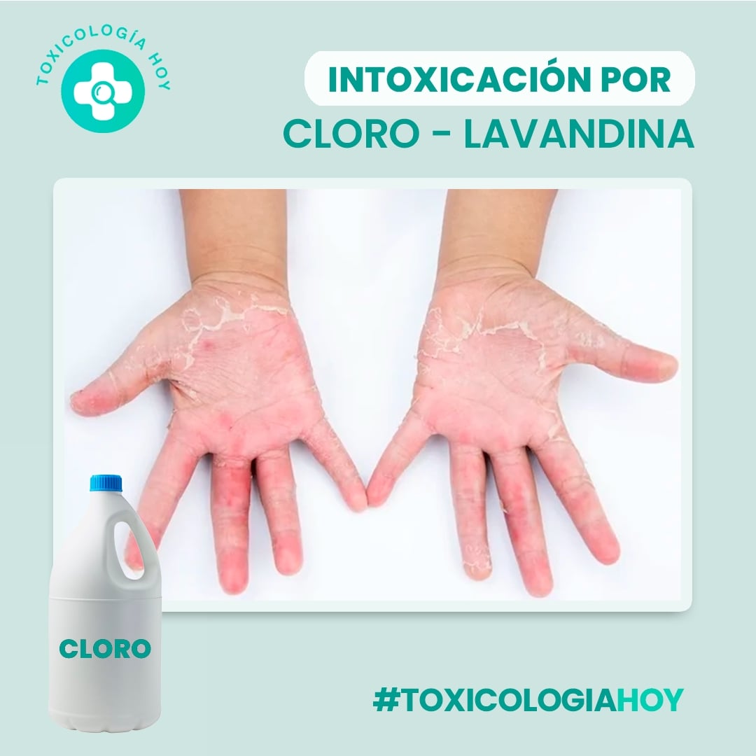 💡 ¿Cómo evitar la intoxicación por #CLORO O #LAVANDINA?

 Sigue siempre las instrucciones del fabricante, diluye adecuadamente el producto y ventila el área mientras lo usas.
 ¡Y recuerda usar guantes y gafas de protección para evitar el contacto directo!