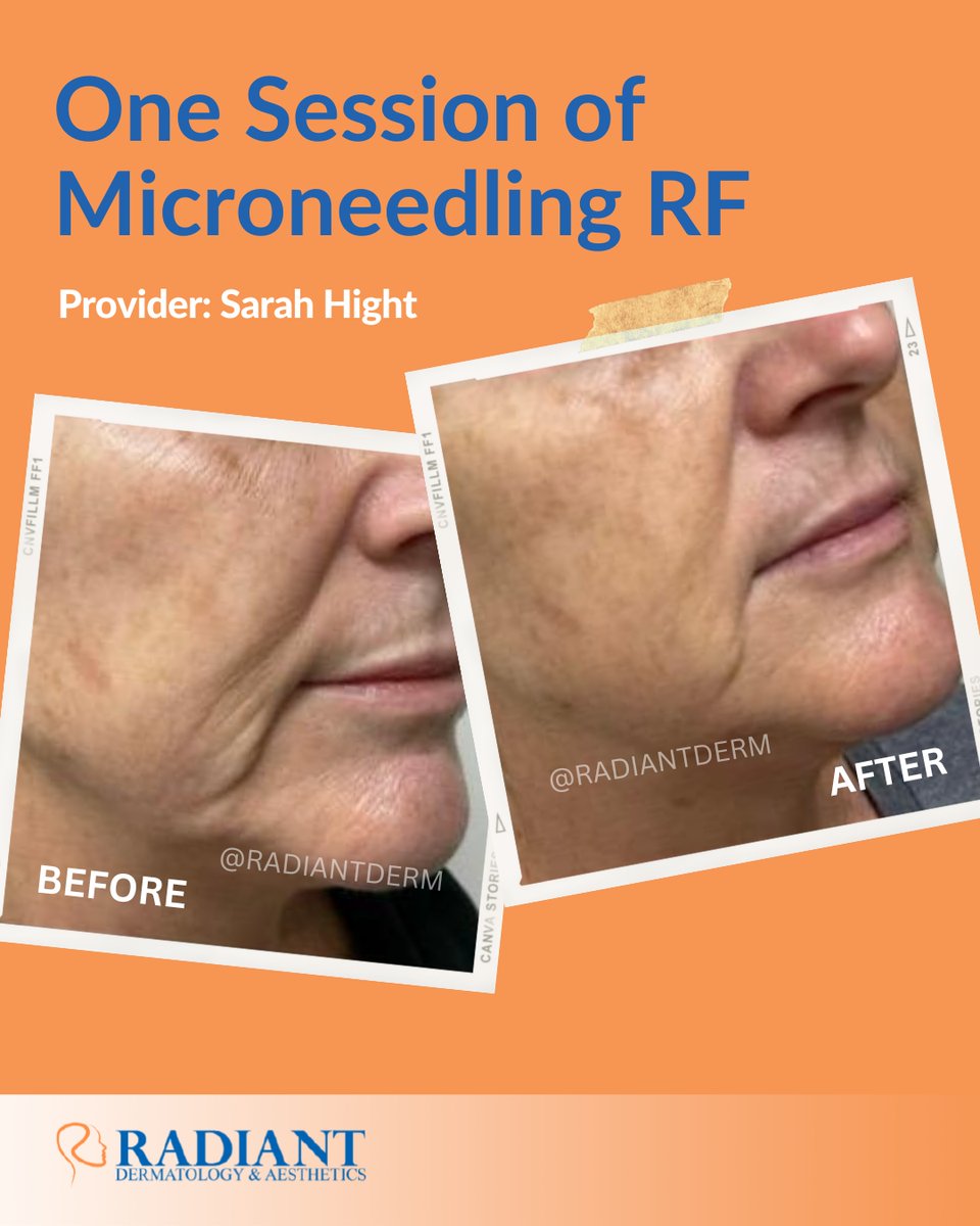 Radiantdermtx's tweet photo. ✨ Check out the amazing transformation of Sarah Hight's patient after just one microneedling RF session!

Book your appointment with our provider Sarah Hight today!
📞 281-973-4159  
📧 info@radiantdermtx.com 
🌐 https://t.co/yZ1KkrugP1
@sarah_hight_aesthetics

#Microneedling https://t.co/KXkNXaErrd