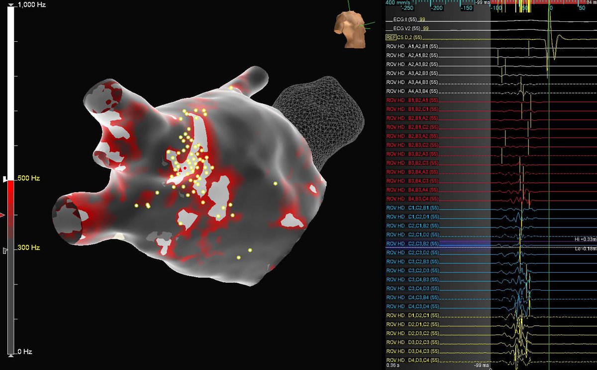 @JuanBurnTerm @Dr_Markman @PennEPFellows @MDTolgaAksu @JRWinterfield @PiotrowskiRoman @Scanav1Mauricio Nice maps Tim! We tried in all our patients, trying to define a way to reproduce the findings, IMO it’s pretty similar to Fractionation. We need to talk !!!