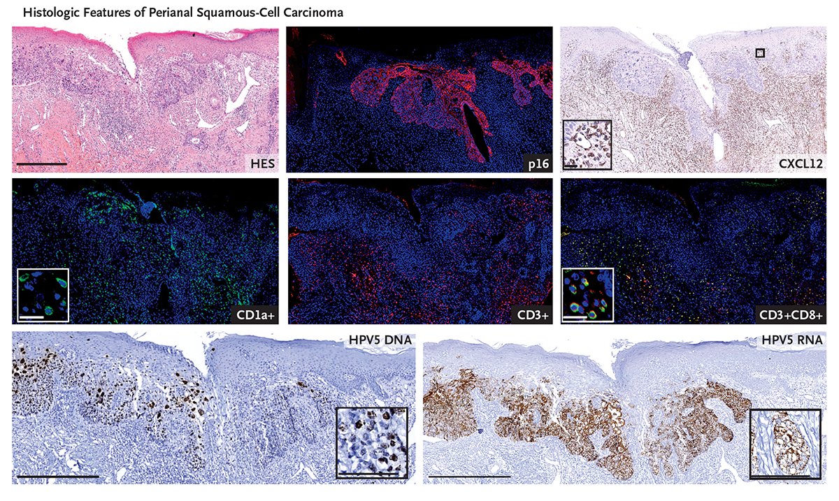 WHIM-like syndrome (warts, hypogammaglobulinemia, infections, and myelokathexis) developed in a patient with gain of CXCR4 function. Plerixafor, a CXCR4 antagonist, led to symptom reduction. Read the full correspondence: nej.md/3PWlfT3