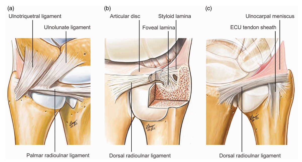 JHSEur's tweet image. Controversies surrounding the surgical management of the Triangular Fibrocartilage Complex (TFCC) have been a topic of debate among orthopedic surgeons and hand 🖐️specialists for years.

🎩/tip - Martin Langer for the images