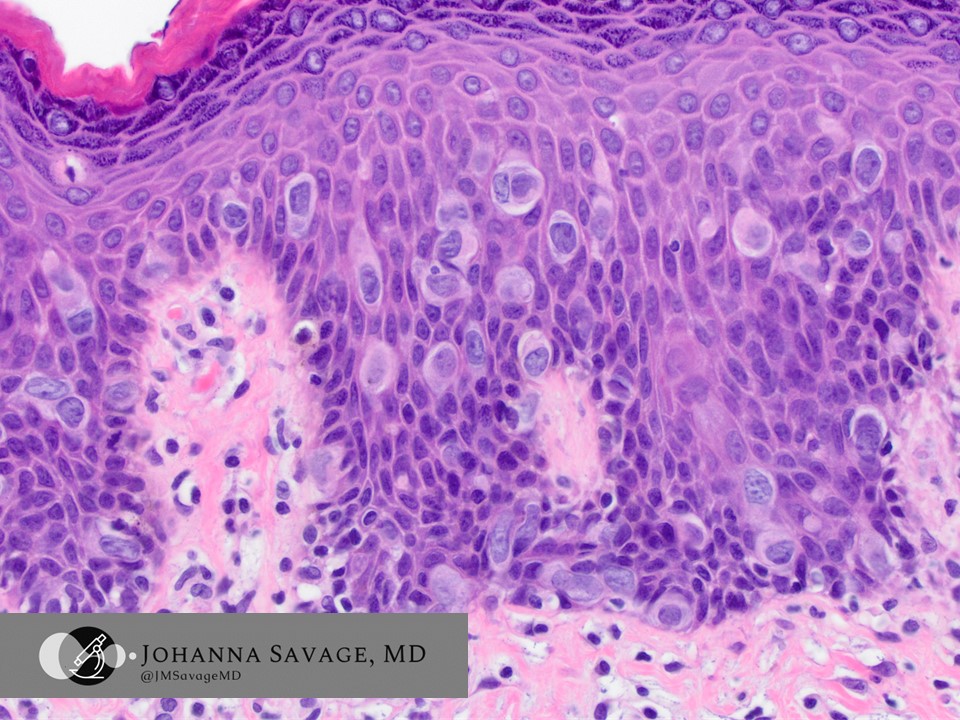 Nice example of this vulvar lesion and a good opportunity to consider the differential considerations for this case. #gynpath #gynaepath #pathtwitter #pathx #vulva