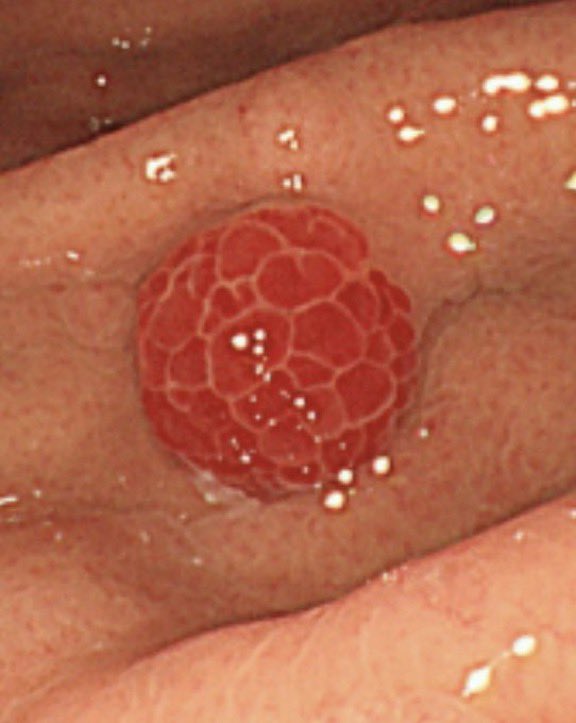 drkeithsiau's tweet photo. Endoscopic finding in the stomach. What’s the diagnosis? https://t.co/AB44yYe2OY