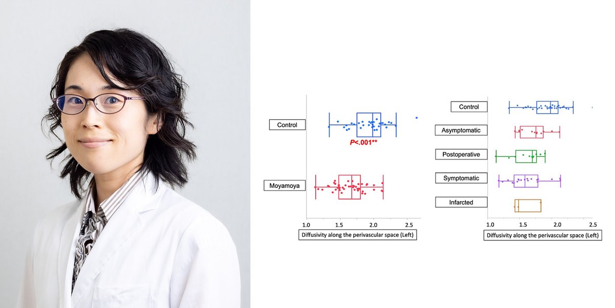 A new paper by Shoko Hara et al: “Decreased Diffusivity Along the Perivascular Space and Cerebral Hemodynamic Disturbance in Adult Moyamoya Disease” in Journal of Cerebral Blood Flow & Metabolism. DOI: doi.org/10.1177/027167… #東京医科歯科大学 #tmdu @_JCBFM