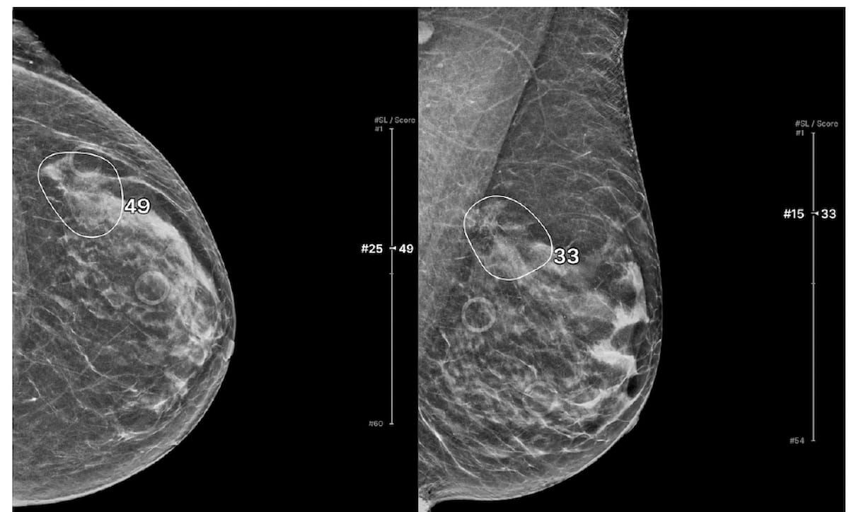 . #Mammography Study: #AI Improves #BreastCancer Detection and Reduces Reading Time with DBT diagnosticimaging.com/view/mammograp… @ACRRFS @ACRYPS @RadiologyACR @ARRS_Radiology @BreastImaging @AAWR_org @RadiologyUSC @RadiologyUcla @MayoRadiology @UCSFimaging @UofURadiology #radiology #RadRes