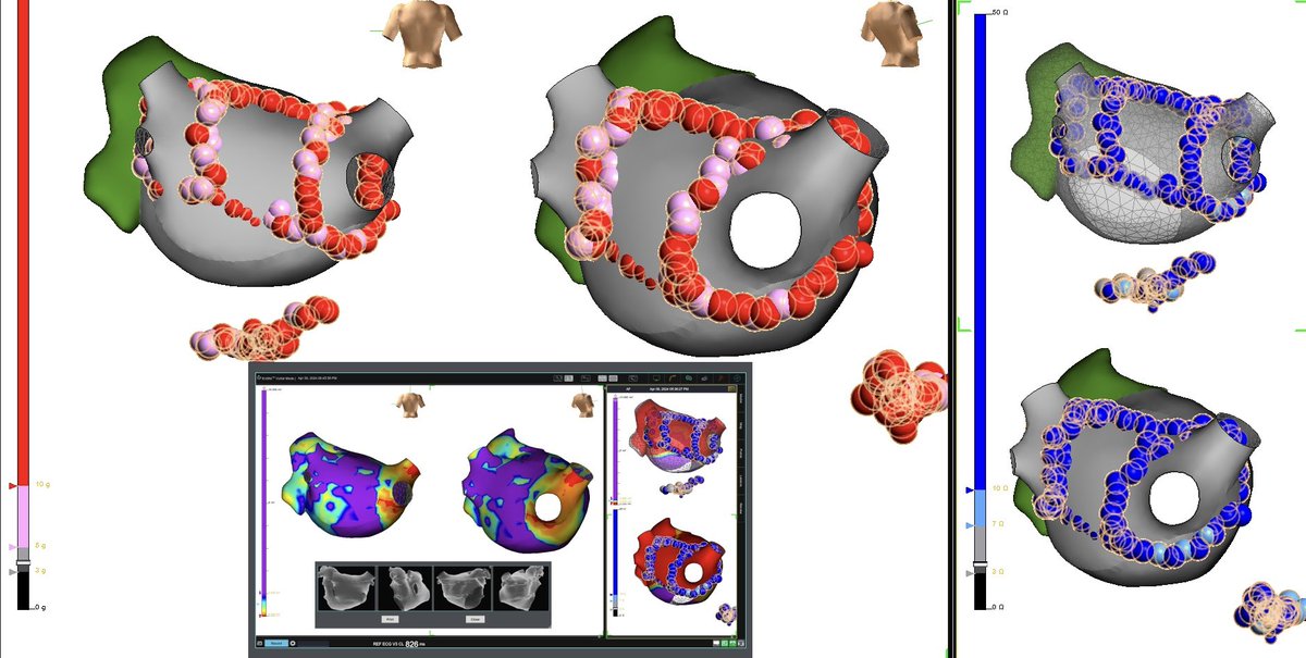 Persistent AF.

A realtime snapshot of #PVI + PW.

HPSD, FPI with #TactiFlex 

Credit <a href="/DrEPCheng/">Edward Cheng, MD, PhD</a>

<a href="/AbbottCardio/">Abbott Cardiovascular</a>