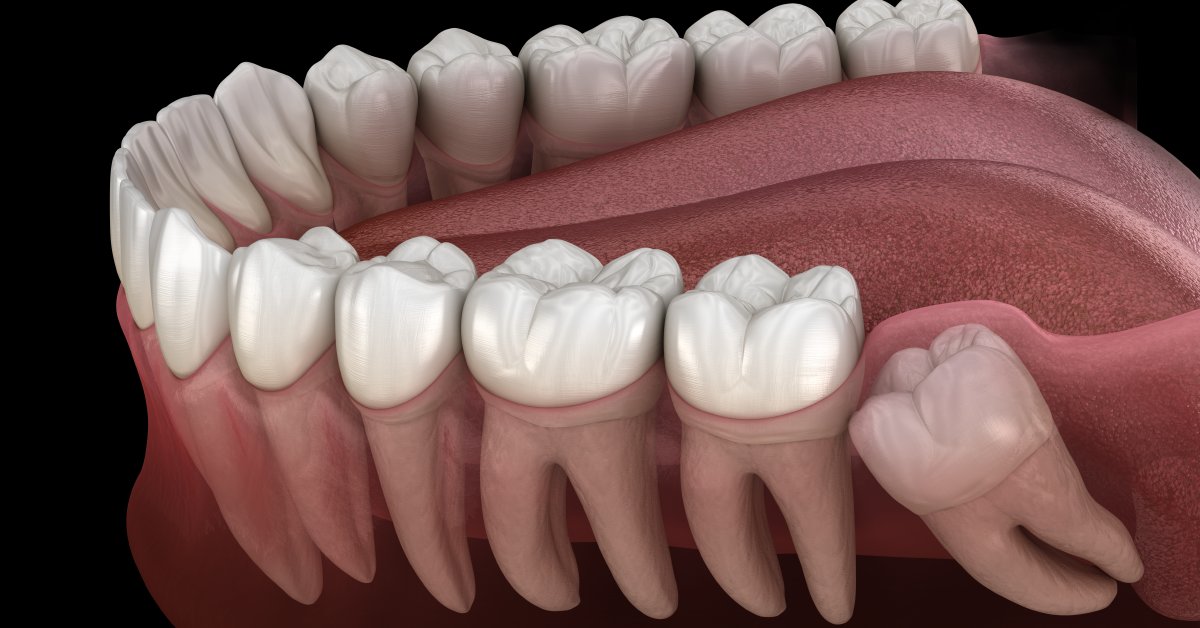 Wisdom teeth are the most commonly missing teeth in adult mouths. You're also more likely to have issues with these molars than with any other teeth. More about wisdom teeth: wb.md/3PXEkEt