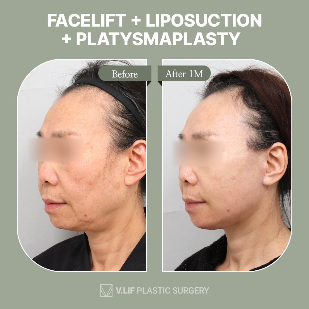 💜Get rid of your double-chin!💜#facelift

#facelift #facelifting #liposuction #aestheticsurgery #platysmaplasty #doublechin #saggyskin #jowls #plasticsurgery #skintightening #browlift #fatloss #koreaplasticsurgery #boardcertifiedplasticsurgeon #Koreabeauty #vlifplasticsurgery