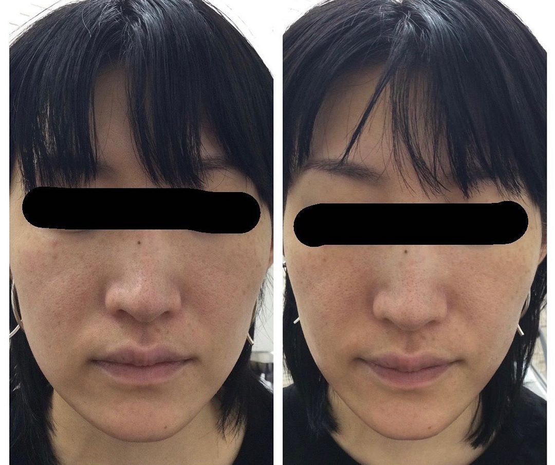 ClairClinic's tweet photo. リアルなお声と共に当院の症例をご紹介していきたいと思います☺️✨
・
🌷30代前半　女性
・
🌷写真　左:施術前　右:施術後
・
🌷頬240ショット　1回施術　
・
🌷お値段39,600円

＃ハイフ　＃小顔　＃たるみ改善　＃ほうれい線なくしたい　＃美容クリニック https://t.co/kIipKFdxq6