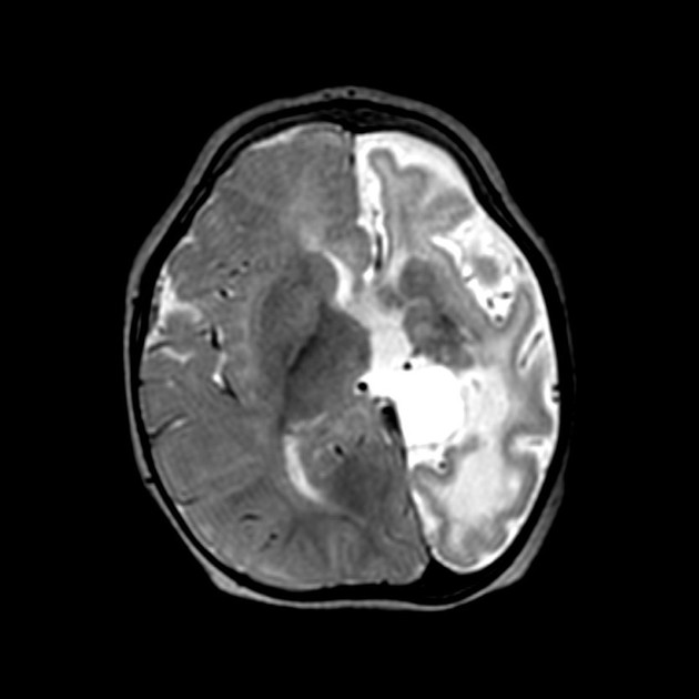 Patient has progressive hemiplegia, drug resistant epilepsy and cognitive impairments.
What's your diagnosis!!
#MedEd #MedX