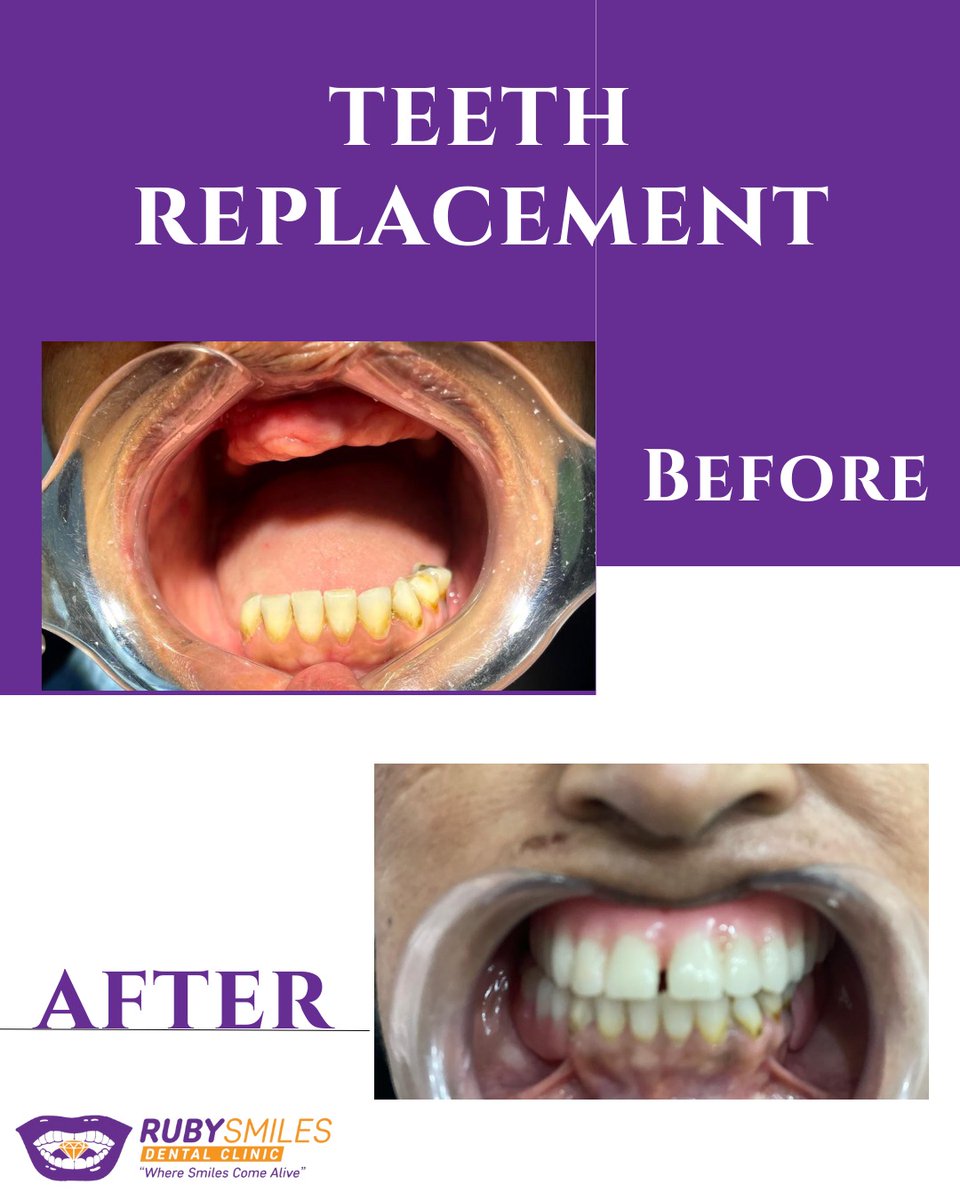 rubyoralclinic's tweet image. Don't worry, we've got you covered with our custom-made dentures. 😍 Say goodbye to uncomfortable gaps and hello to a confident smile. 😉 Let us help you rock that denture life with ease. 💪

 #teethreplacement #denture #TeethImplants #rubysmilesdentalclinic   #affordabledentist