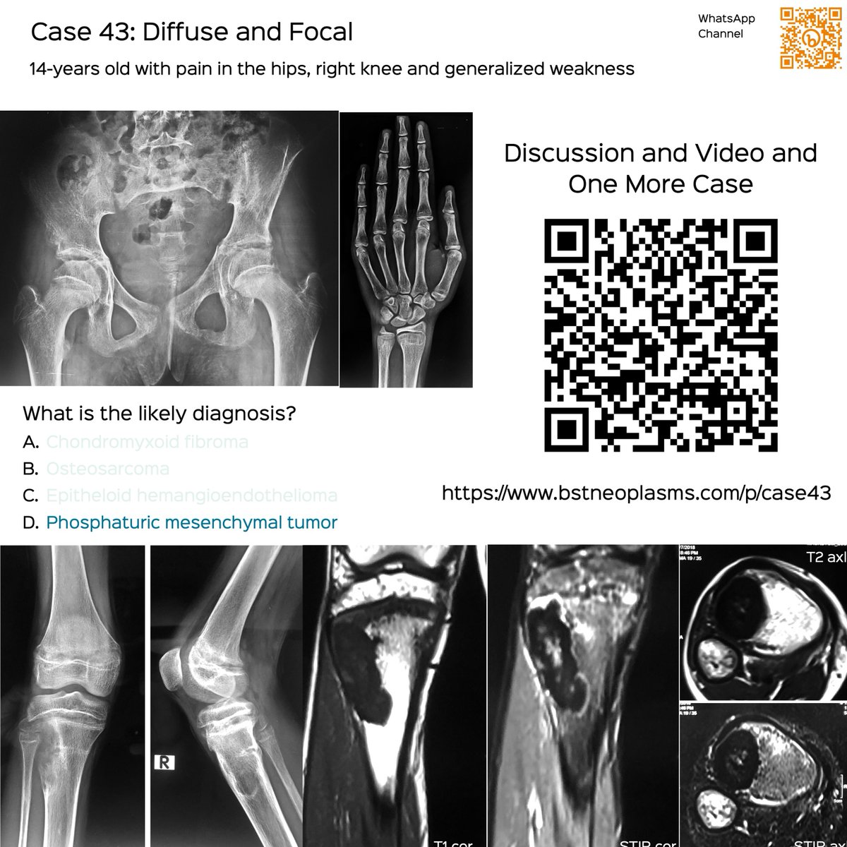 Case 43: Diffuse and Focal

14-yrs old - pain hips, knee & weakness

Answer is PMT

Discussion, video and another case
bstneoplasms.com/p/case43/

#bstneoplasms #radres #bonetumor #PMT #TIO #osteomalacia #rickets