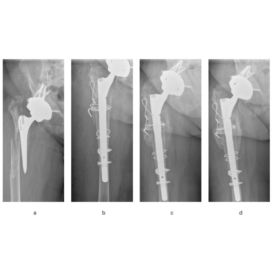 A modified transfemoral approach and a modular, tapered, fluted cementless revision femoral component and distal interlocking screws in patients with a deficient isthmus, can result in satisfactory outcomes. #Arthroplasty #BJJ #Fracture ow.ly/kuG250R4psO