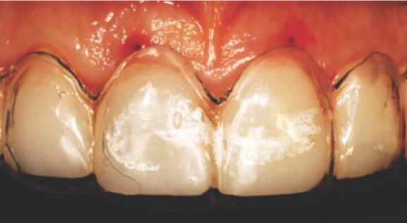 💡|Surgical guide is used to mark the position of the future gingival margin