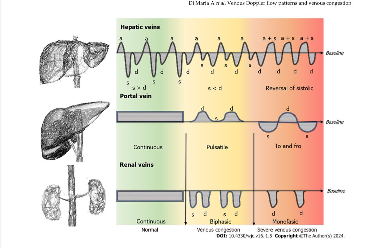 -🤔 Entendiendo de a Poco 📈 el Score #VExUS❤️‍🩹💦

•📈 Las venas #hepáticas muestran un patrón de onda ‘a’, ‘s’, y ‘d’, que representan diferentes fases del ciclo cardíaco. El cambio en estos patrones indica niveles de congestión.

•🟢 La vena #portal muestra una onda que se