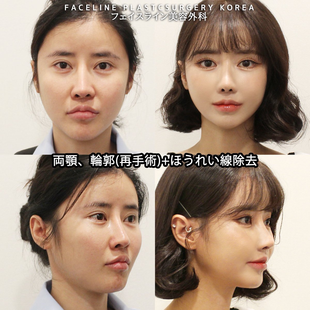 手術内容] 両顎、輪郭(再手術)+ほうれい線除去 🇯🇵日本通訳スタッフが常駐しています🤗  🚩お問合せ/予約:https://t.co/pxnidII3hf 症例写真 https://t.co/F7FQUBw8fQ…  #フェイスライン美容外科 #イジンス院長 #韓国整形 #両顎 #輪郭 #人中 #両顎, image size:1200x1200
