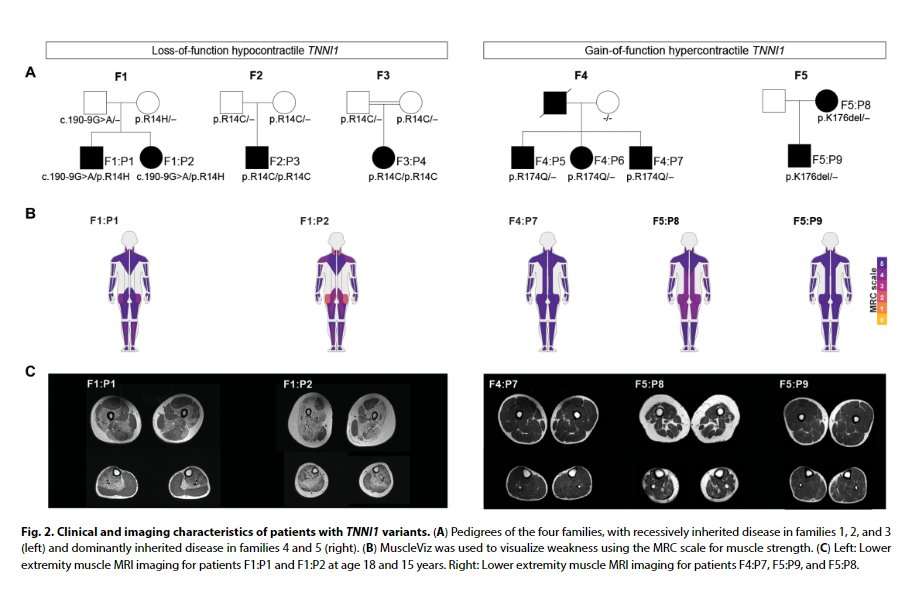 Sandra Donkervoot et al established that pathogenic variants in TNNI1 result in either a hypo- or hypercontractile disease mechanism which, may be amendable to a troponin activator, or the myosin inhibitor mavacamten, respectively. @RobertB_R science.org/doi/full/10.11…