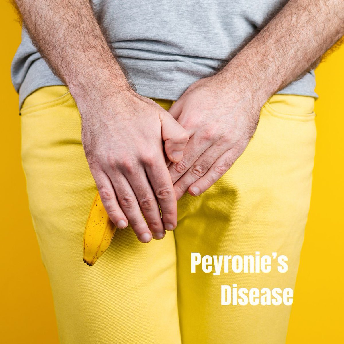 Curious about Peyronie's disease beyond the basics? It's a condition with real impact and many layers. What more do you want to learn? Share your questions and let's delve deeper together! buff.ly/3SUaRgG #peyroniesdisease #menshealthexpert #urology #WardOfYourHealth