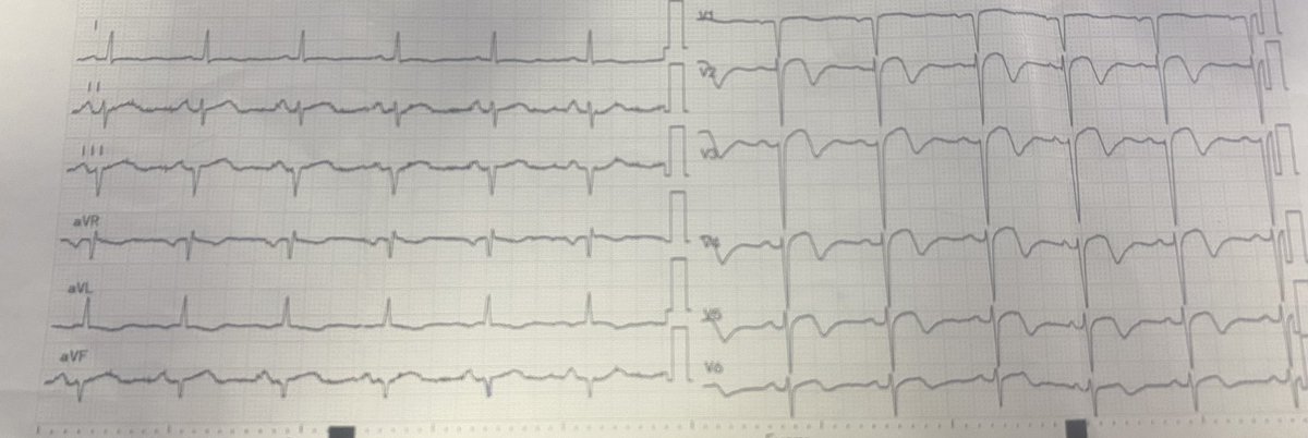 50 y/o, admited  one week ago as a case of anterior STEMI, today presented with angina, prevoius ecg will be on the comments 
-Echo : 
Inferior wall hypokinesia 
Septal wall hypokinesia 
CPK normal today.