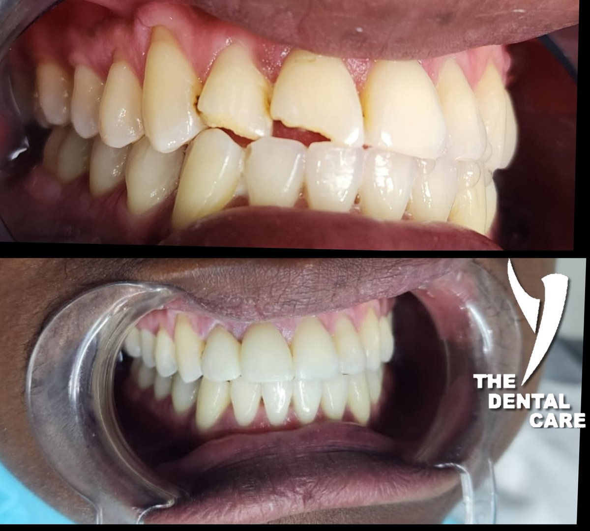 We specialize in restoring broken teeth, helping you regain your smile and confidence. Say goodbye to dental issues and hello to a brighter, healthier smile! #DentalCare #SmileRestoration'
Library Gardens ,Polokwane 015 280 0142 Whatsapp 063 588 8906