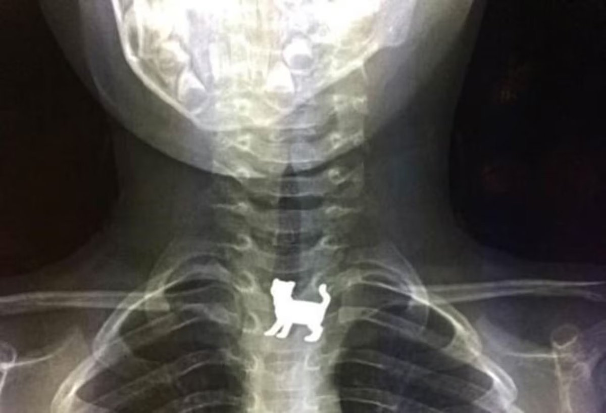 What does this X-ray show? How did that animal reach there? (Source: Medscape; Sam Shlomo Spaeth)
